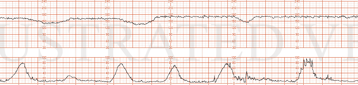 STRIP 59 1. FHR 160-170 Intermittent late decelerations initially