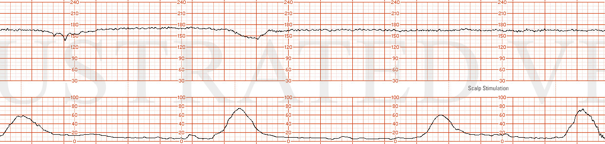 STRIP 60 1. Fetal tachycardia -- 165 Some intermittent late decelerations Minimal variability No response from fetal scalp stimulation