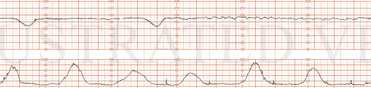 STRIP 61 1. Fetal tachycardia, 165 Minimal variability 2 late decelerations with first 3 contractions, then 15 mins of moderate variability with no lates