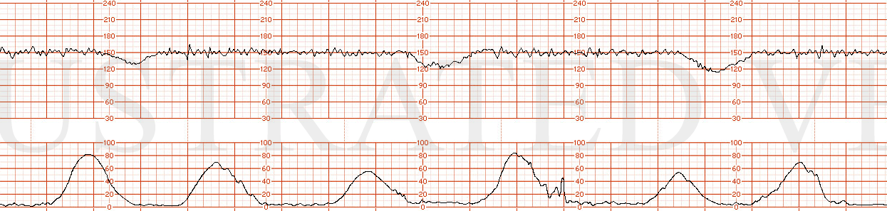 STRIP 62 1. recurrent late decelerations and moderate variability