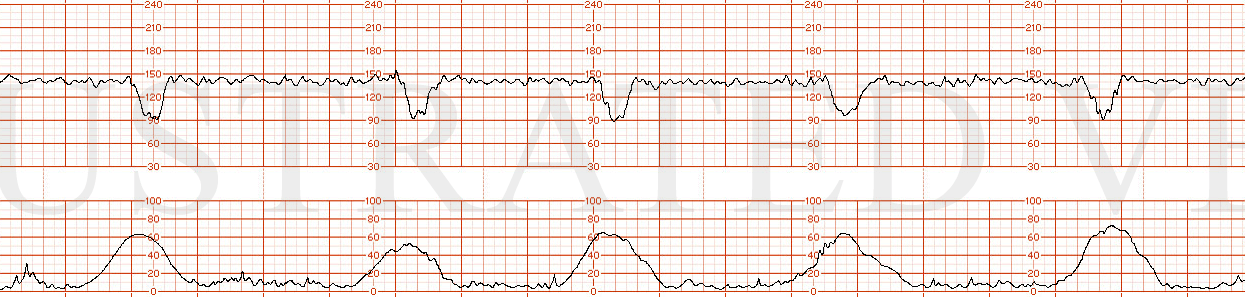 STRIP 63 1. Mild variable decelerations (nadir at 90 bpm x 30-40 seconds) Moderate variability FHR baseline 140 Regular contractions