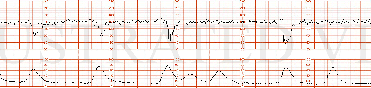 STRIP 64 1. Variable decelerations that become progressively deeper Variability moderate
