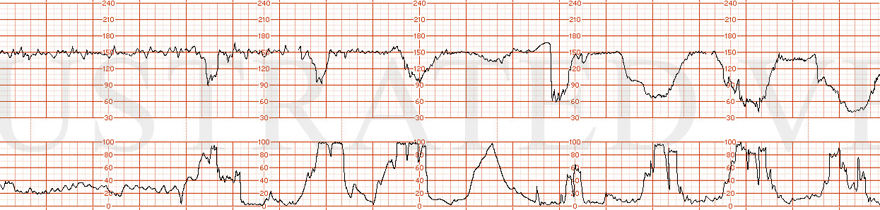 STRIP 65 1. Variable decelerations that become progressively deeper Variability changing from moderate to minimal