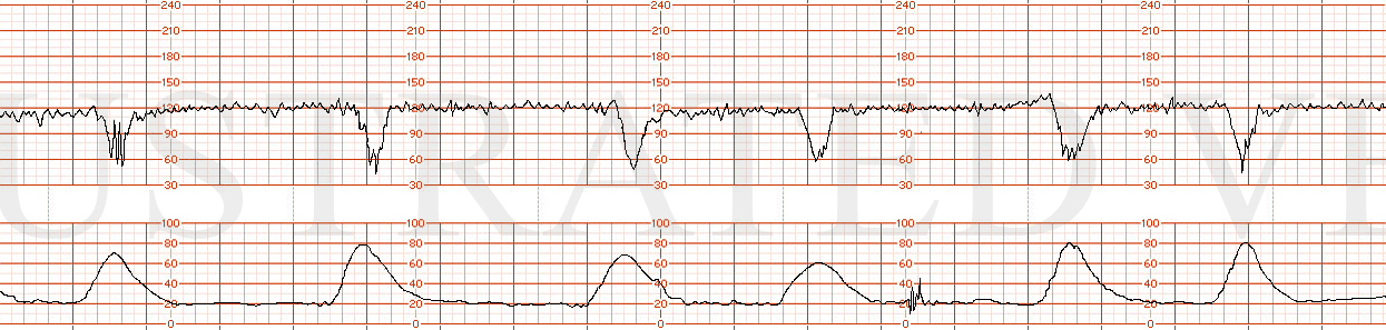 STRIP 66 1. Category II with variable decelerations