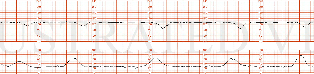 STRIP 67 1. Absent variability Persistent late decelerations