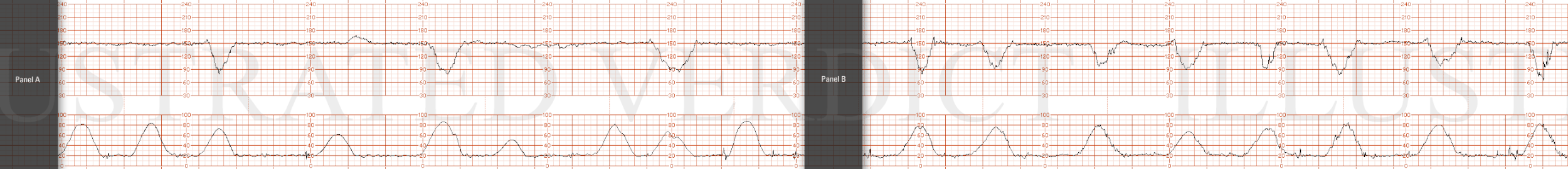 STRIP 69 1. Panel 20 minutes Nine contractions, each 50-60 sec long, in last 20 minutes. 2nd, 3rd and 4th contraction to long, about 10 secs, 6th needs 15 secs off,  Baseline rate at +/- 150 bpm over 20 minute panel with minimal variability Three mi…