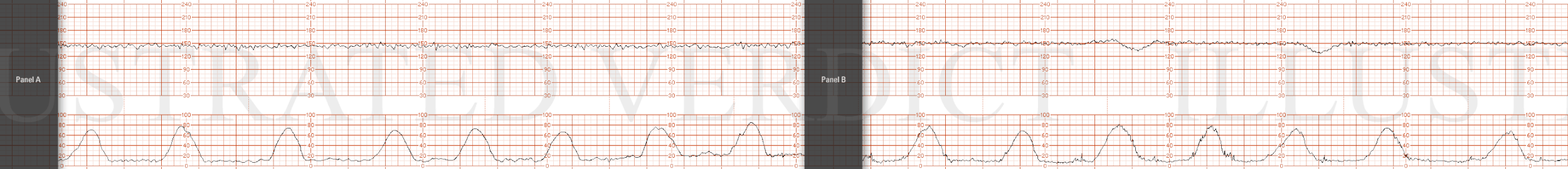 STRIP 71 1. 1st panel: Contractions – average of 4 contractions / 10 minutes each symmetric x 60 seconds 3rd too long 30secs, 4th too long 20secs,  Baseline 1 – 145 with average variability Decelerations 1 - none Accelerations1 – none 2nd panel: Con…