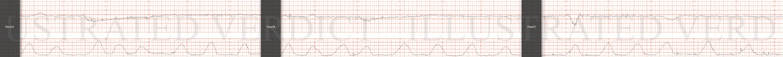 STRIP 72 1. 1st and 2nd panel: Contractions: 7-8 60-70 second contractions in 20 min. (2nd too long by40 secs, 4th take off 10 secs, last 2 take off 20-30secs) See exception below re deceleration associated contractions – 3 run together concluding 3…