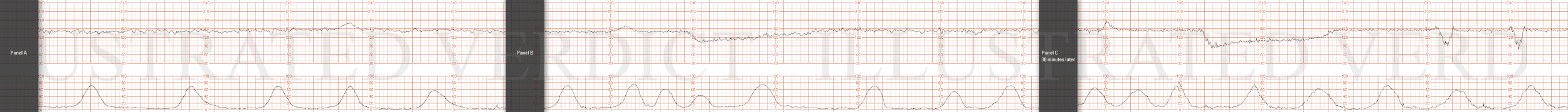 STRIP 73 1. 1st and 2nd panel: Contractions: 7-8 60-70 second contractions in 20 min. See exception below re deceleration associated contractions – 3 run together concluding 30 sec or so before end of deceleration. (2nd too long, last 2 also to long…