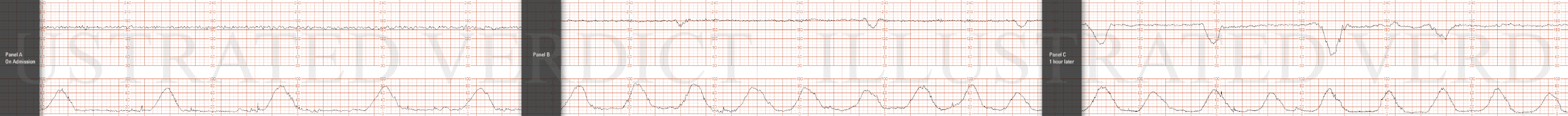 STRIP 74 1. 1st and 2nd panel: Ctxs 8 in 18 or 9 in 20 min, each 60 sec Baseline 180 bpm with minimal variability at 2-3 bpm Decels – 30 second variable decels to 160, 155, 160 bpm nadir each with prompt return to baseline with one of three contract…