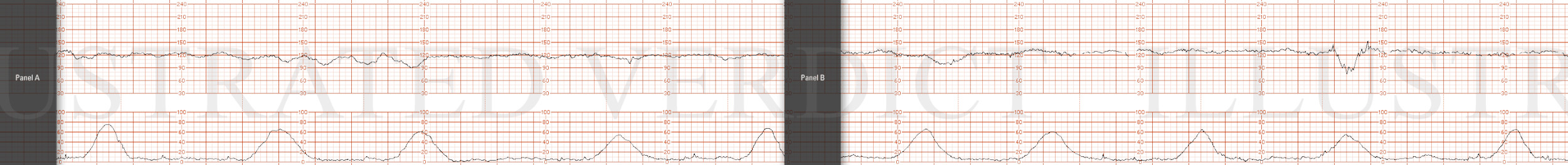 STRIP 75 1. 1st panel: Ctxs – every 4-5 minutes Baseline – 120 bpm  Decels - ? Baseline undulations vs ? late decels - with minimal (possibly absent) variability. Lates responsive to IU Resuscitation Variability – minimal /possibly absent Accels - n…