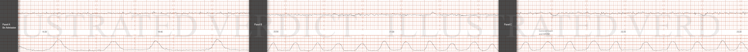 STRIP 76 1. Ctxs – 11 contractions each 50 sec 55 sec 50 sec, etc duration (3rd contraction from end too long) Baseline -140bpm with mod variability -7-8 bpm Decels - None Accels – None until scalp stimulation to be written on strip done at 14 min i…