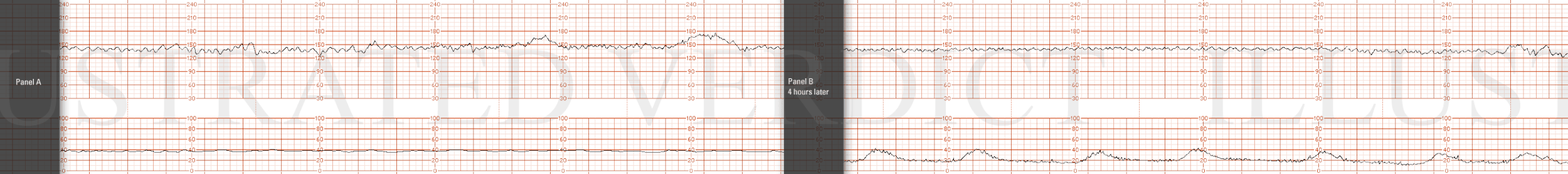 STRIP 79 1. There is a short portion with less variability and possibility a sinusoidal pattern. However at the end of it there are two accelerations. Given the benign association between Nisentil and sinusoidal, and the presence of these two accele…