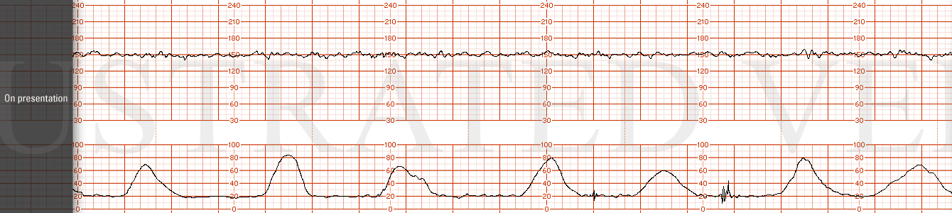 STRIP 80 1. On presentation. The initial FHR tracing has a base line of 150 bpm, moderate variability with no accelerations or decelerations. Contractions are every 2-3 mins