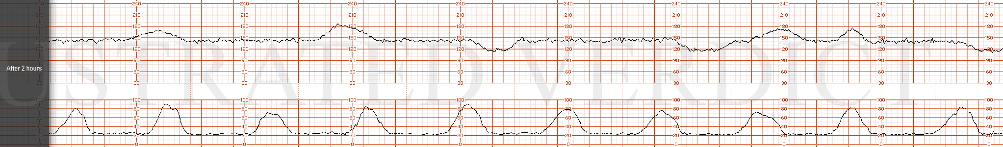 STRIP 81 1. After 2 hours. baseline 140 bpm, moderate variability with accelerations and late decelerations with about 50-60% of contractions over 30 mins. The nadir is at 25 bpm below the baseline. Contractions are every 3 mins.