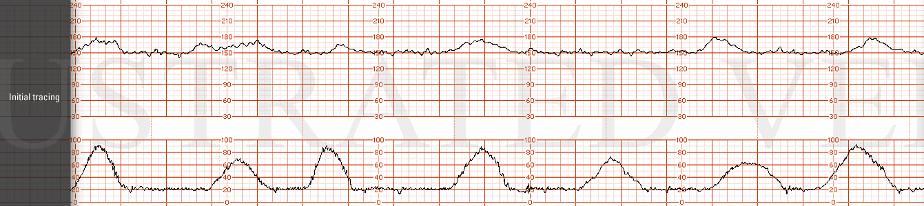 STRIP 83 1. Initial tracing; The initial FHR tracing has a base line of 150 bpm, moderate variability with accelerations and no decelerations. Contractions are every 2- 3 min