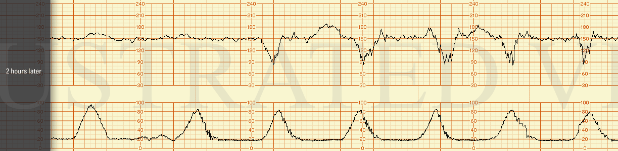 STRIP 84 1. 2 hours later; baseline 150 bpm, moderate variability with accelerations and recurrent variable decelerations with a nadir at 85 bpm lasting 40 sec (however variable decels are not progressing to deeper and longer). Contraction pattern i…