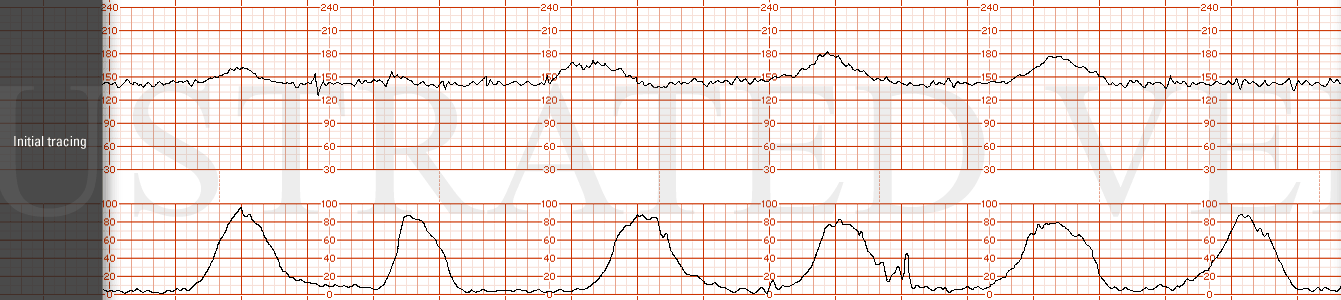STRIP 85 1. Initial tracing.The initial FHR tracing has a base line of 140 bpm, moderate variability with accelerations and no decelerations. Contractions are every 3 mins.