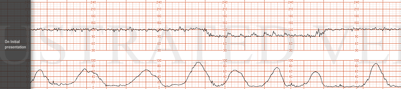 STRIP 87 1. On initial presentation. The initial FHR tracing has a base line of 120 bpm, moderate variability with no accelerations. Shortly after arriving she has a prolonged deceleration to 90 lasting 6 minutes. Contractions are every 2-3 mins