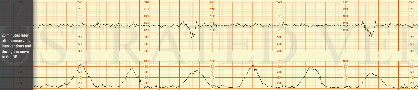 STRIP 88 1. 20 minutes later after conservative interventions and during the move to the OR. baseline 140 bpm, moderate variability with no accelerations. No further prolonged decelerations, however there are intermittent variable decelerations occu…