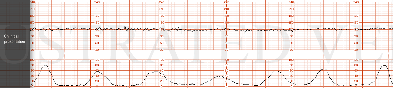 STRIP 89 1. On initial presentation. The initial FHR tracing has a base line of 120 bpm, moderate variability with no accelerations or decelerations. Contractions are every 2-3 mins