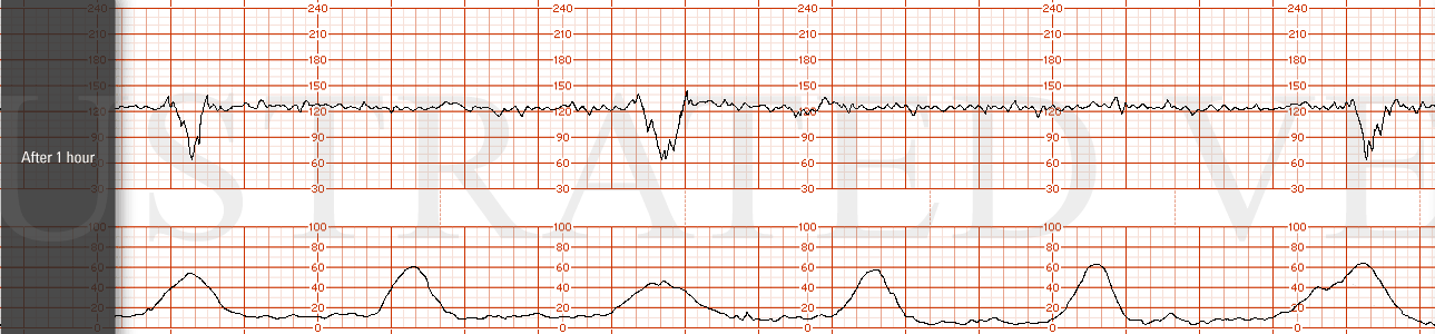 STRIP 90 1. After 1 hour. baseline 125 bpm, mod variability without accelerations and intermittent recurrent variable decelerations with a nadir at 65 bpm lasting 30-40 sec. Contractions are every 3 mins.