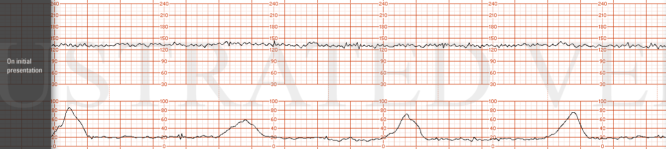 STRIP 92 1. On initial presentation. The initial FHR tracing has a base line of 130 bpm, moderate variability with no accelerations or decelerations. Contractions are every 5 mins