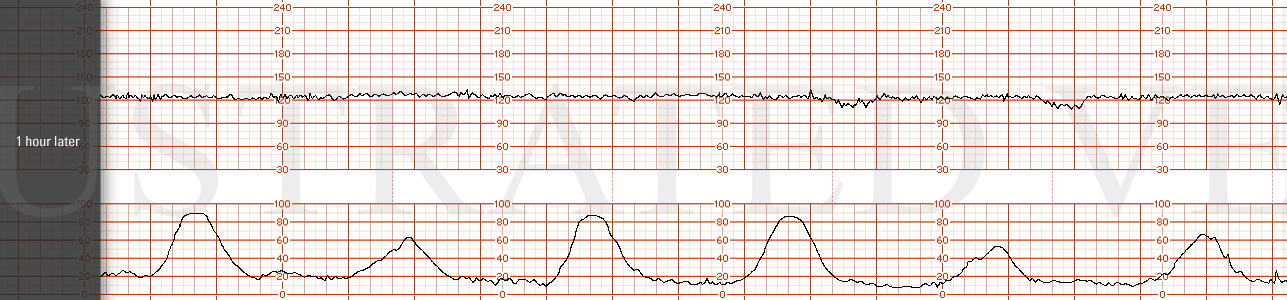 STRIP 93 1. 1 hour later. baseline 125 bpm, min variability with no accelerations and 2 late decelerations noted over the last 20 mins. The nadir is 10 bpm below the baseline. Contractions are every 3 mins. In these illustrations, make sure we have …