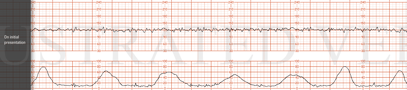 STRIP 95 1. On initial presentation. The initial FHR tracing has a base line of 120 bpm, moderate variability with no accelerations or decelerations. Oxytocin is started. Over the next 3 hours she progresses to 4/-1/60%. Membranes are ruptured and o…