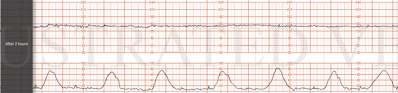 STRIP 96 1. After 2 hours. baseline 140 bpm, min variability without accelerations or decelerations over the last 30 min. Contractions are every 2-3 mins.