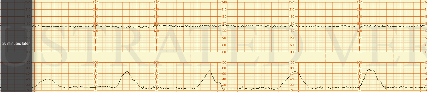 STRIP 97 1. 30 minutes later after conservative interventions. Tracing is very, very close to second part of context tracing (but not so close it looks like a copy). BUT contractions have slowed to 1 every 4 minutes