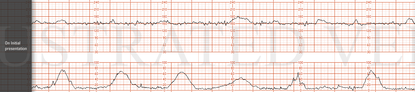 STRIP 98 1. On initial presentation. At this time the FHR tracing had moderate variability, accelerations, baseline of 150 and no decelerations.