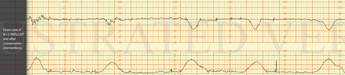 STRIP 99 1. exam now of 9/+1/100%/LOP and after conservative interventions. the accelerations have disappeared, the baseline is unchanged and recurrent variable decelerations developed initially with a nadir of 120 bpm but now the nadir is 95 bpm. T…