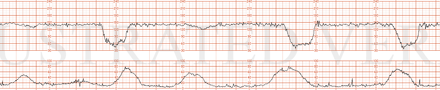 STRIP 101 1. Significant variable decel