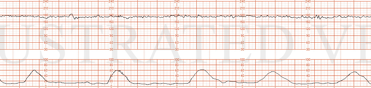 STRIP 102 1. Tachycardia