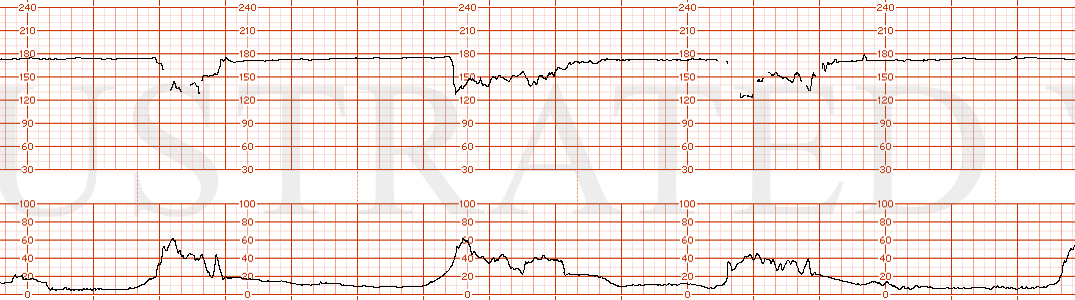STRIP 104 1. Minimal variability, tachycardia