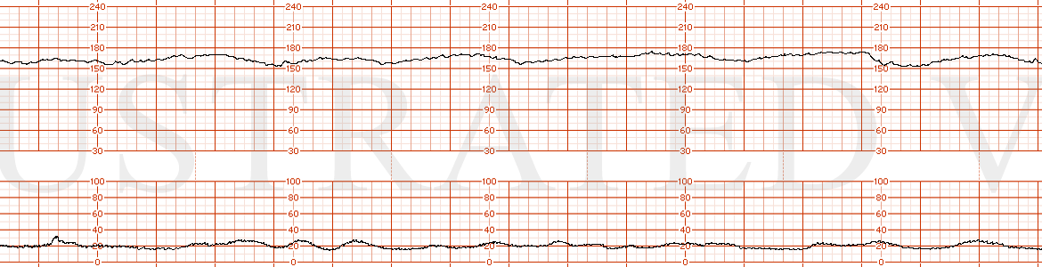 STRIP 105 1. Baseline 170, minimal to moderate variability, recurrent late decelerations