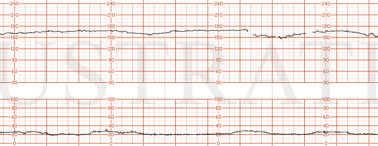 STRIP 106 1. Baseline 170, minimal to moderate variability, recurrent late decelerations