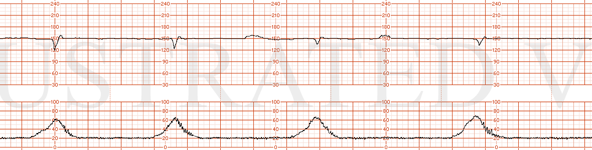 STRIP 108 1. 150s baseline with minimal variability (0-4) and moderate recurrent variable decelerations and one severe variable deceleration. Contractions are every 3 minutes. Normal and Category II trending to III with 20 minutes of tracing.