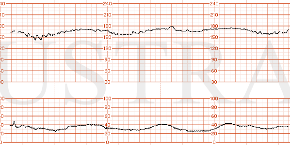 STRIP 107 1. Baseline 170 moderate variability and recurrent late decelerations, contractions every 2 minutes