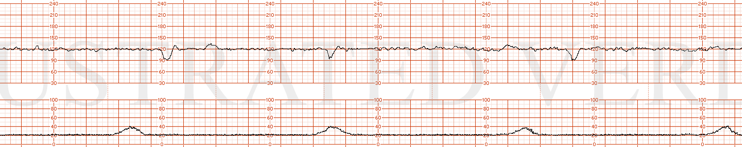 STRIP 109 1. Baseline of 120s with moderate variability. The tracing has accelerations with mild (quantification previously addressed) variable decelerations lasting 15 seconds to 90 bpm with contractions. Contractions are every 5 minutes and normal…