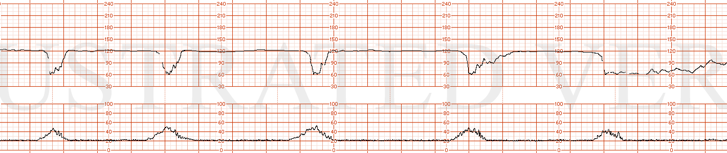 STRIP 110 1. Minimal variability with recurrent variable decelerations which are dipping to 60 bpm and lasting 30-40 seconds and one variable deceleration to the 60’s lasting 1 minute and one
