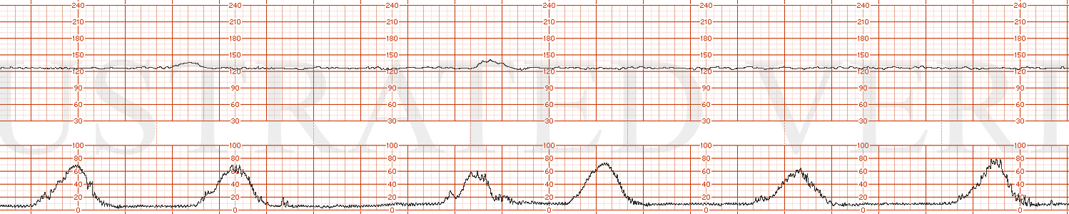 STRIP 111 1. Baseline 125, min variability, occasional acceleration