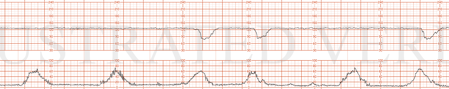 STRIP 112 1. The FHT shows the following characteristics: Baseline 125, min-mod variability and occasional late decelerations