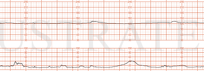 STRIP 113 1. Baseline 125, min variability, occasional acceleration Toco: contractions are irregular every 2-5 minutes