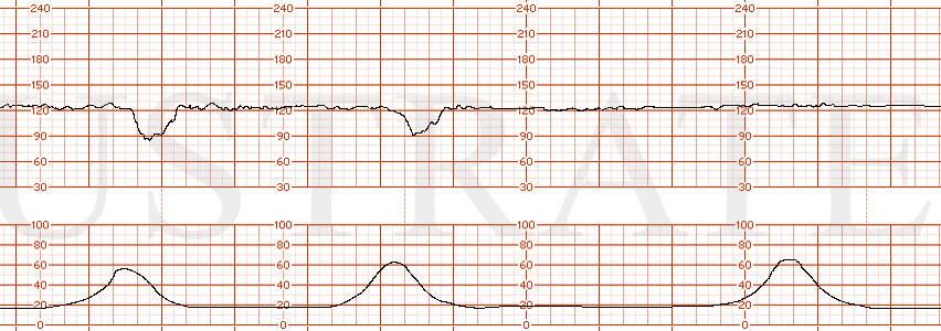 STRIP 114 1. The FHT shows the following characteristics: Baseline 125, min-mod variability and occasional late decelerations Toco: as above