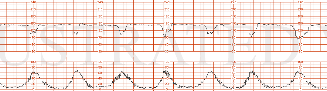 STRIP 115 1. Baseline 140, minimal variability with recurrent variable decelerations Toco: every 2 minutes