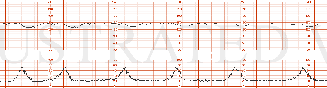 STRIP 116 1. The FHT showed the following characteristics: Tracing would show  category II – baseline 140, minimal variability with recurrent variable decelerations. Tracing is worsening category II---periods of min and mod variability and now recur…