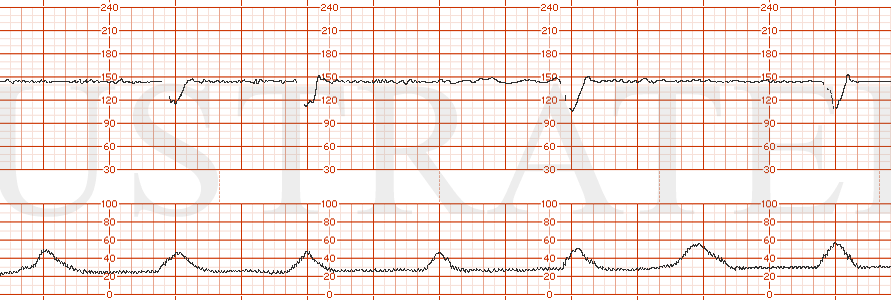 STRIP 117 1. Baseline 145, minimal variability, occasional variable decelerations Toco: every 2 minutes