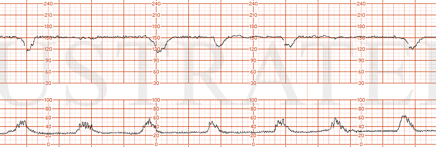 STRIP 118 1. Baseline 150, periods of minimal and moderate variability, intermittent late decelerations Toco: every 2 minutes